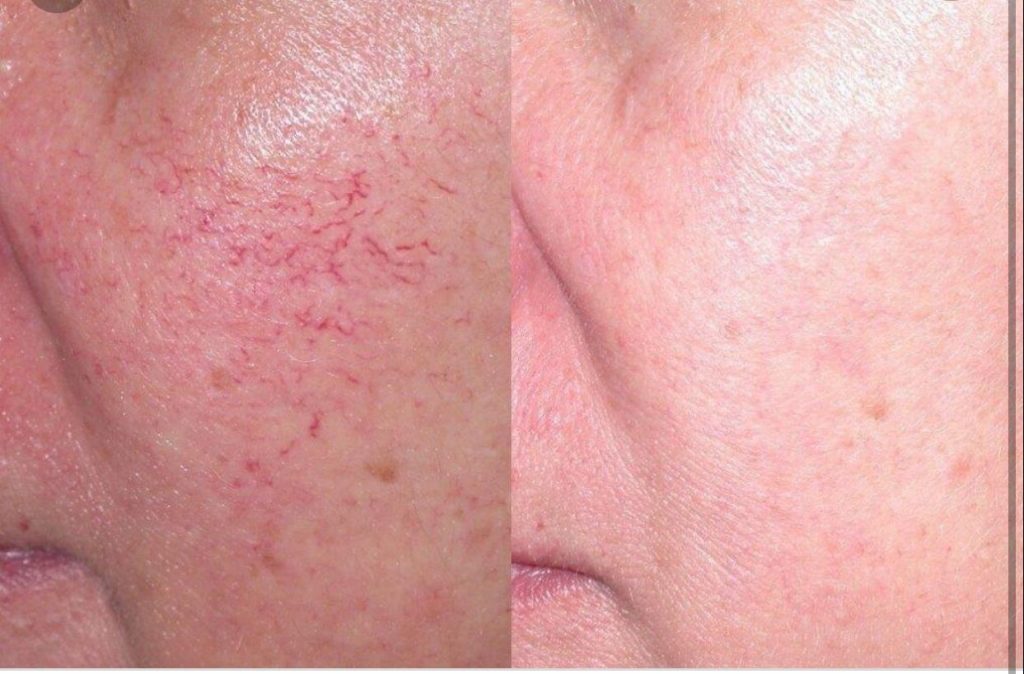 IPL Thread Vein Removal London at Beautify Aesthetics